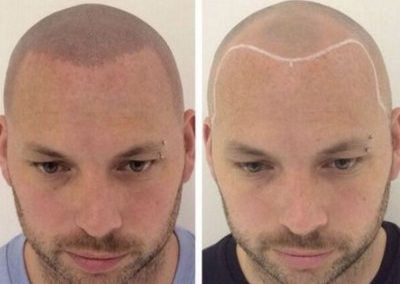 antes despues micro capilar