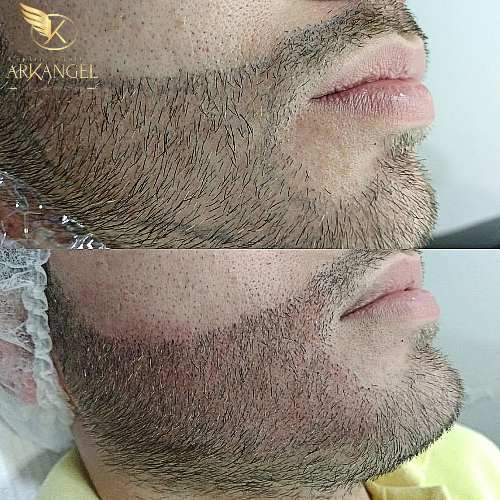 BARBA
