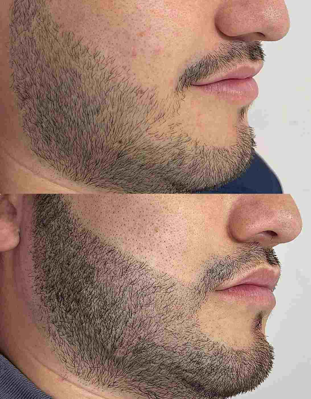 MICRO BARBA